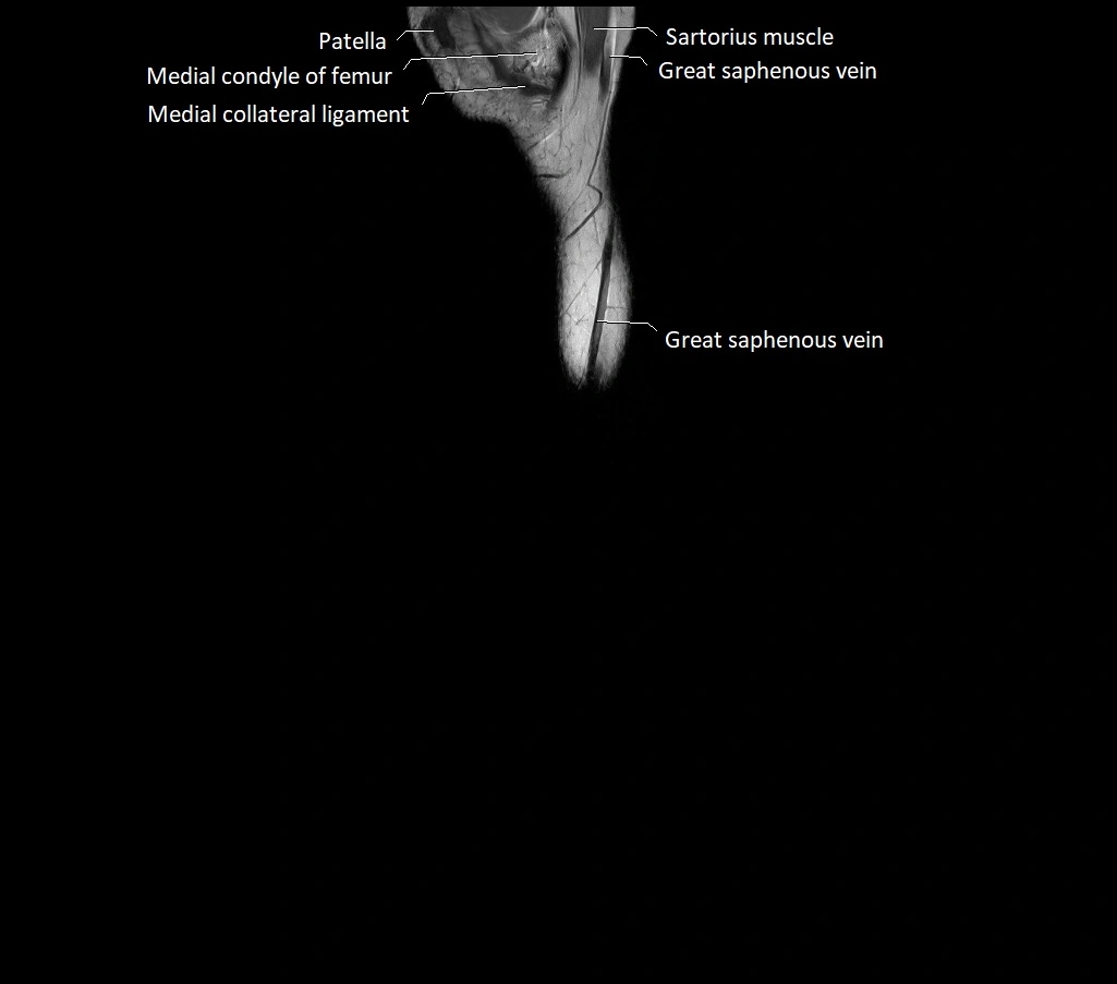 Lower leg sagittal anatomy 3T MRI image 29.webp